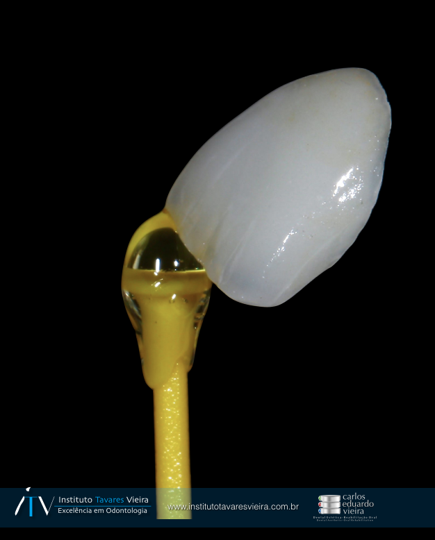 Lente de contato dental - Crédito: Divulgação/Instituto Tavares Vieira