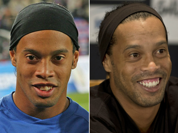 O antes e depois de Ronaldinho Gaúcho, que gastou quase R$150 mil para construção do novo sorriso - Crédito: Divulgação